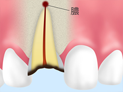 根管治療の種類